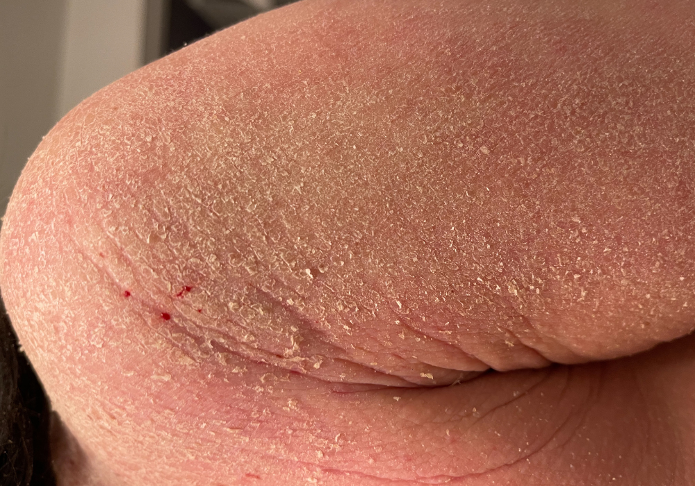 Topical Steroid Withdrawal