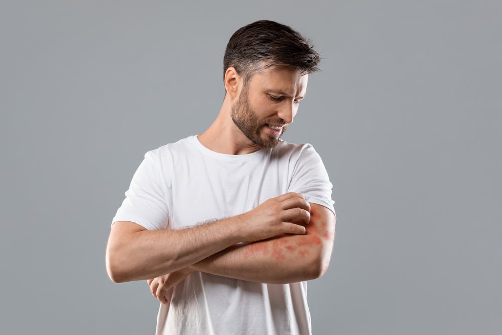 3 tips tegen jeuk bij eczeem