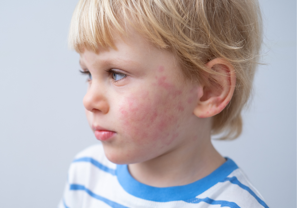 Allergische reactie gezicht (4)