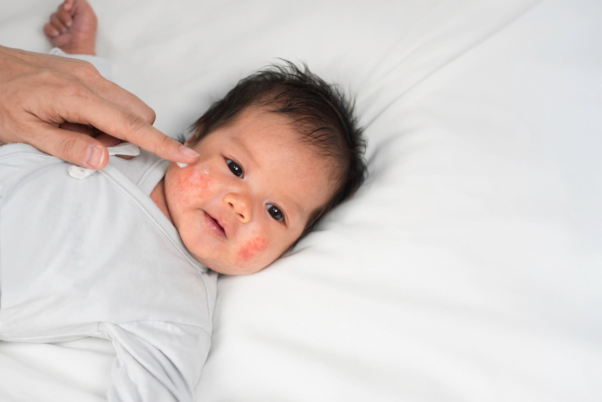Eczeem gezicht baby afbeelding