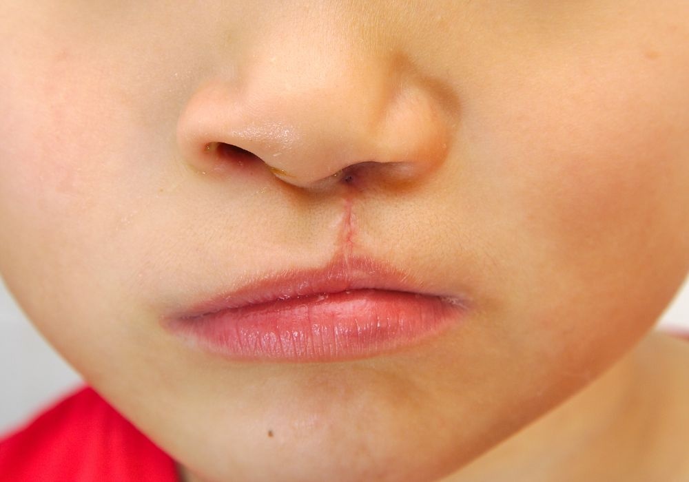 Litteken op de lip behandelen blog Dermatologie-winkel