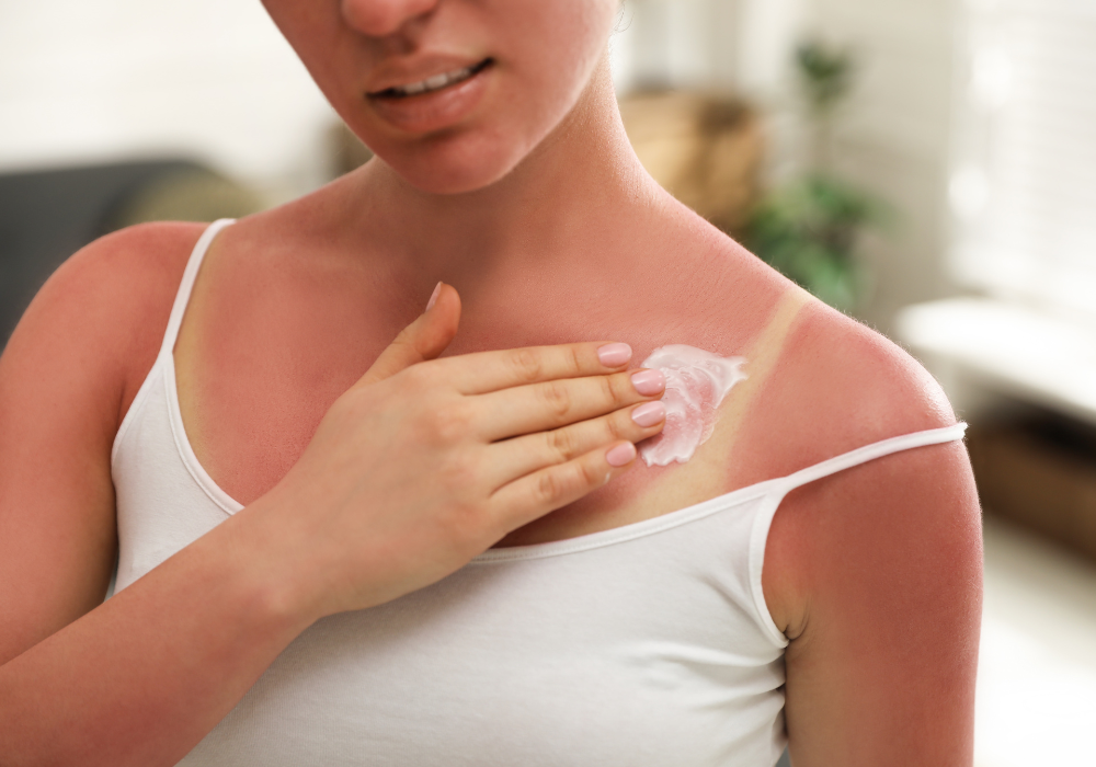 Verbrand door de zon