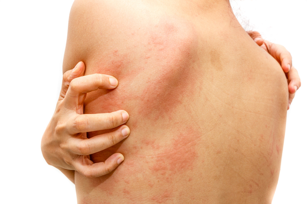 huidirritatie of allergie