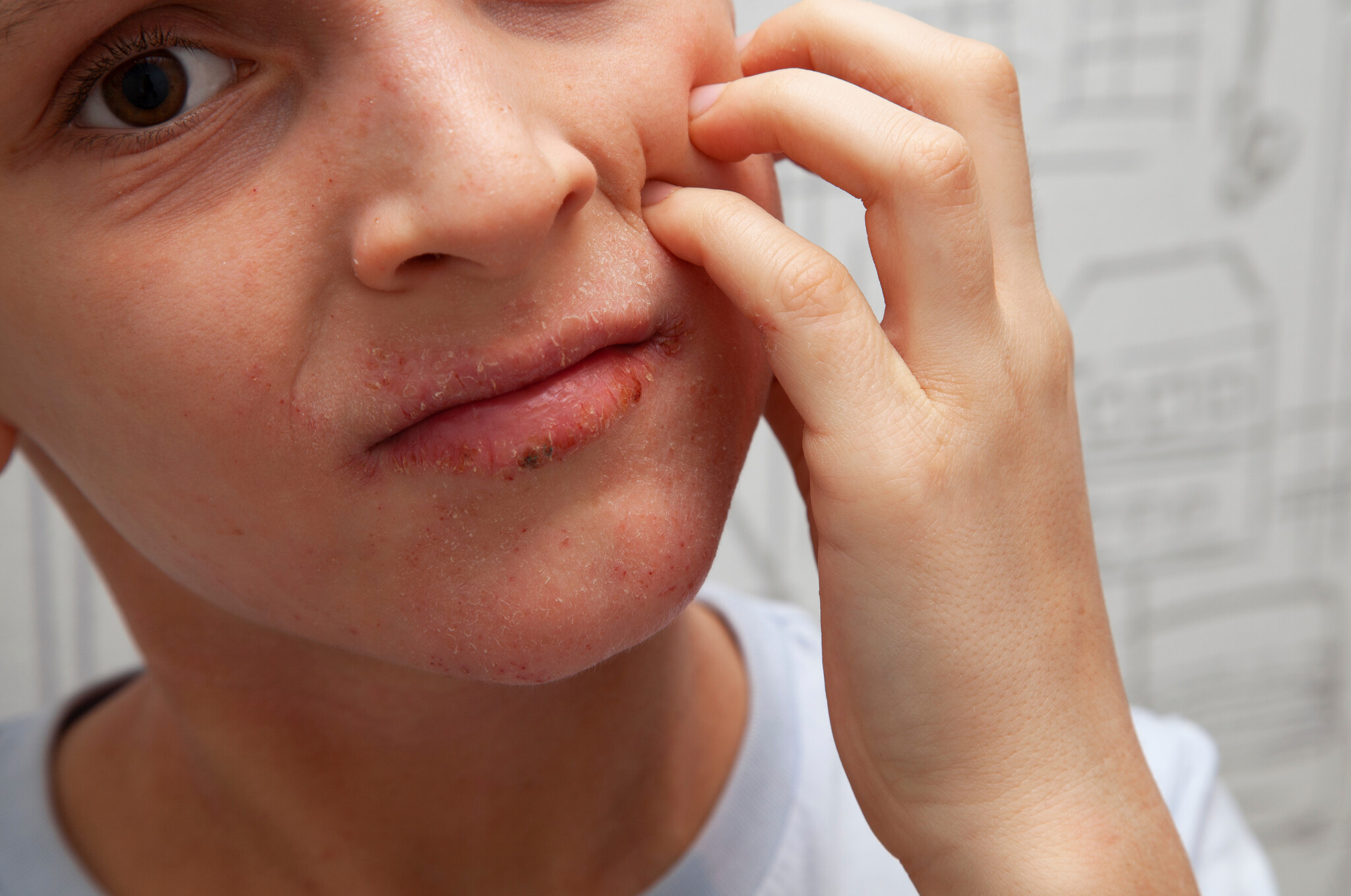 eczeem lippen