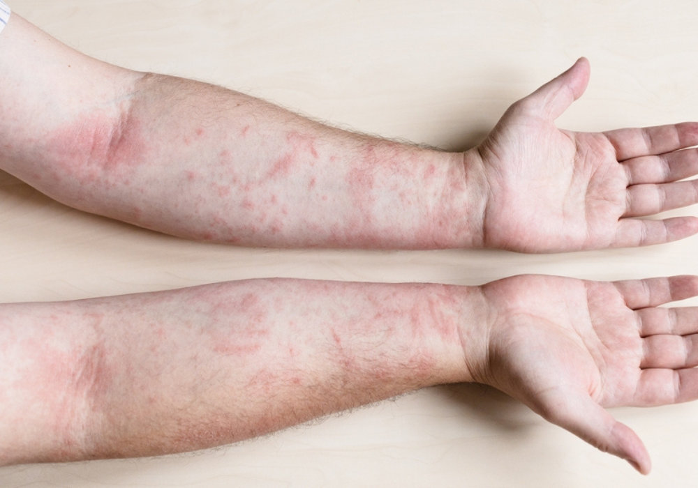 contactallergie huid